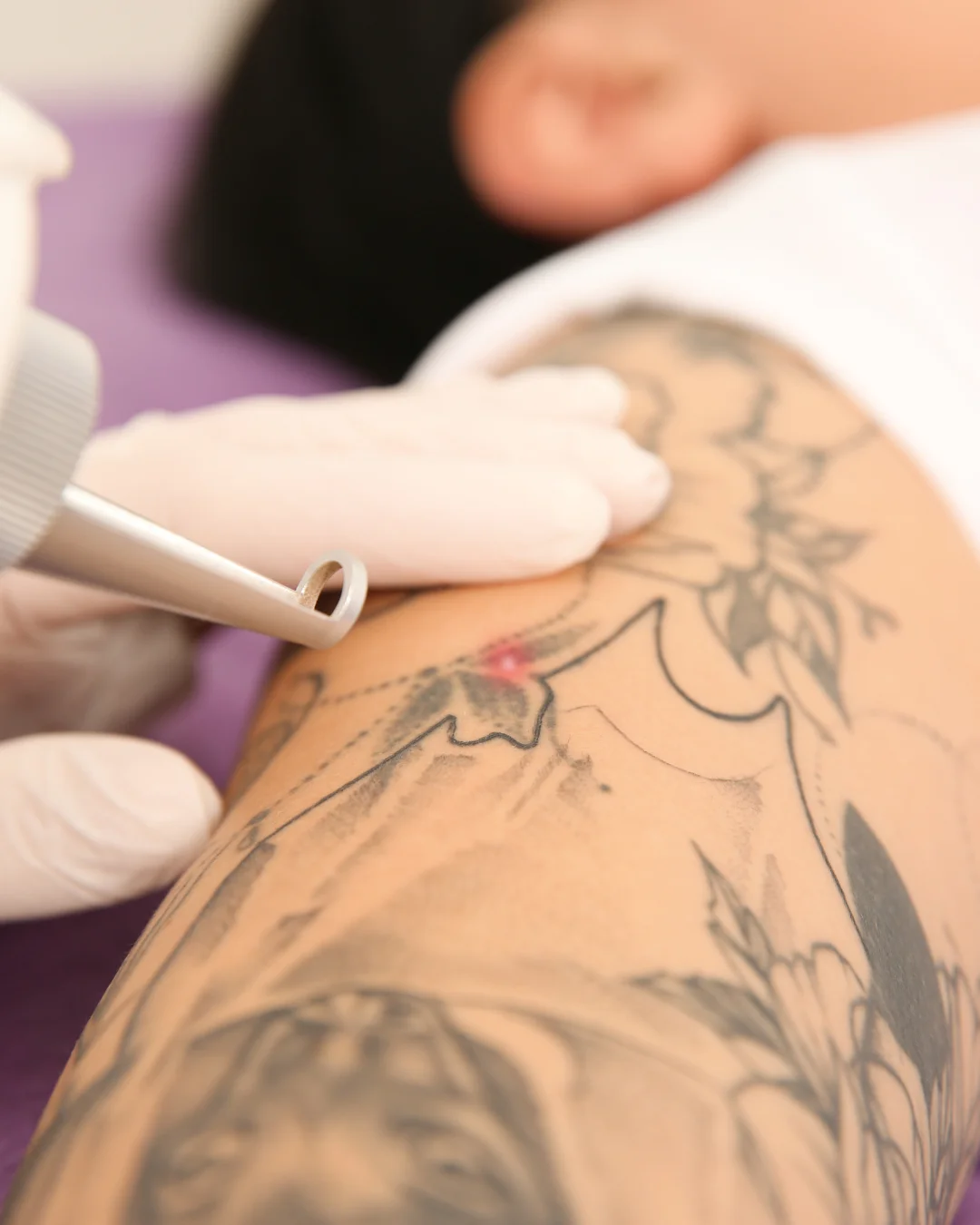 Précautions après un détatouage laser pour favoriser la cicatrisation de la peau