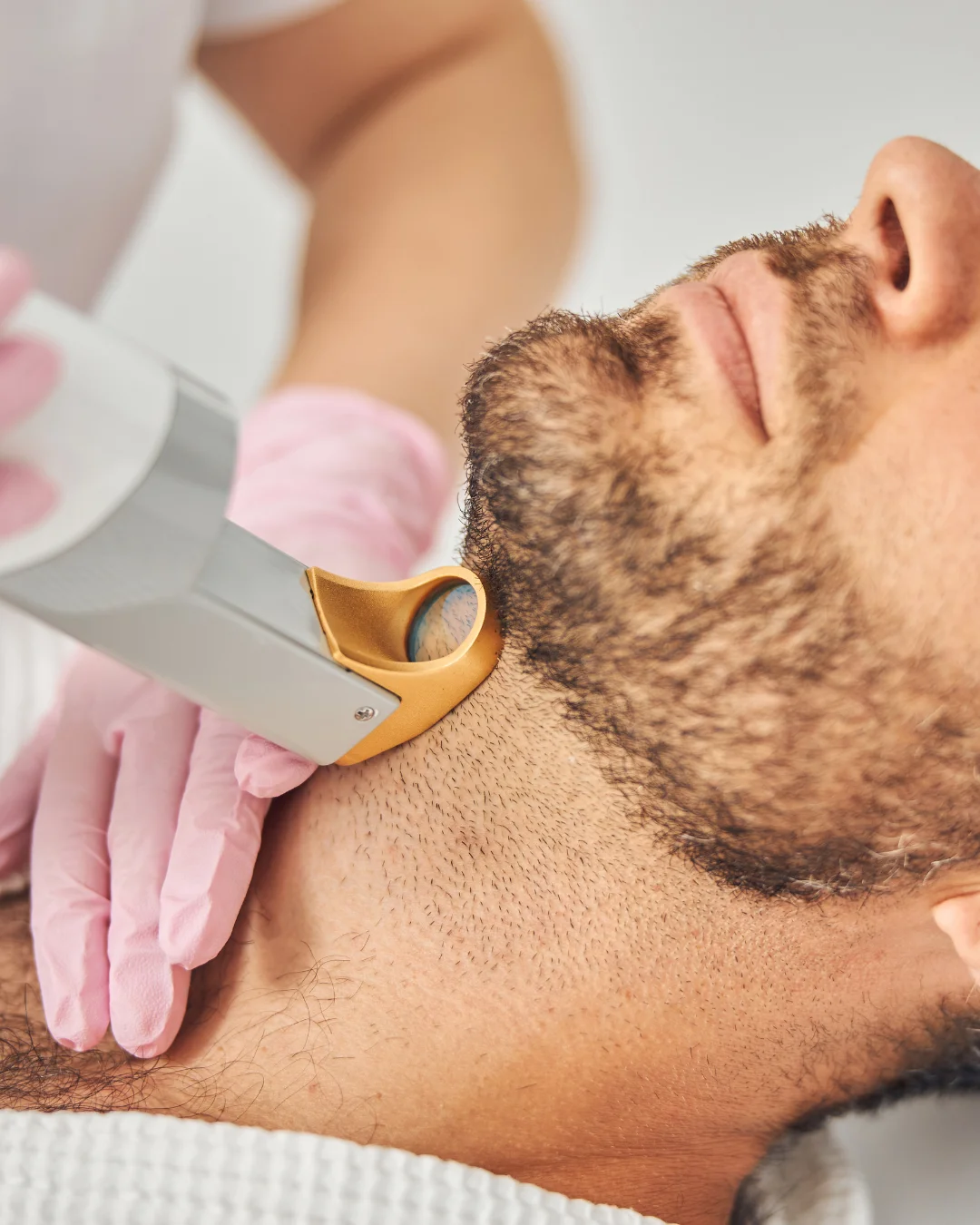 Épilation laser homme pour une réduction durable de la pilosité masculine