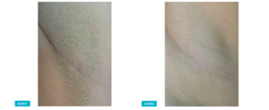 resultats d'épilation laser femme