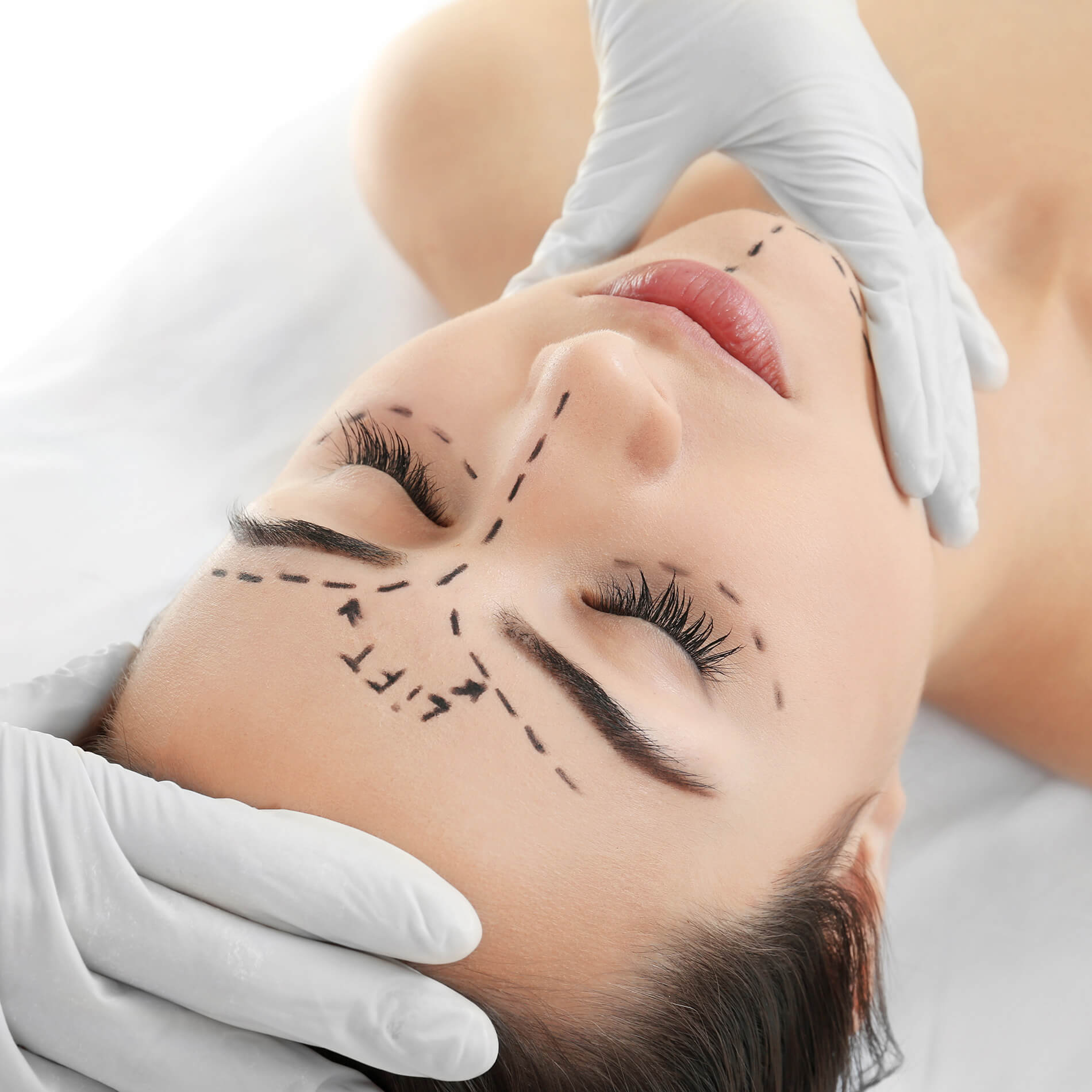 épilation laser