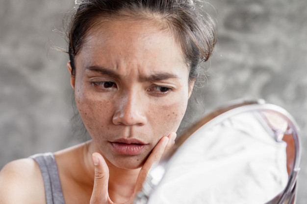 traiter le melasma ou hyperpigmentation hormonale