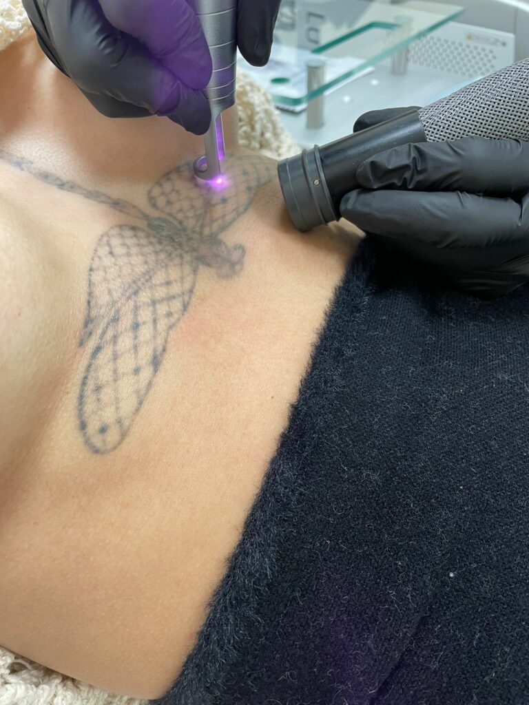 détatouage laser à nice