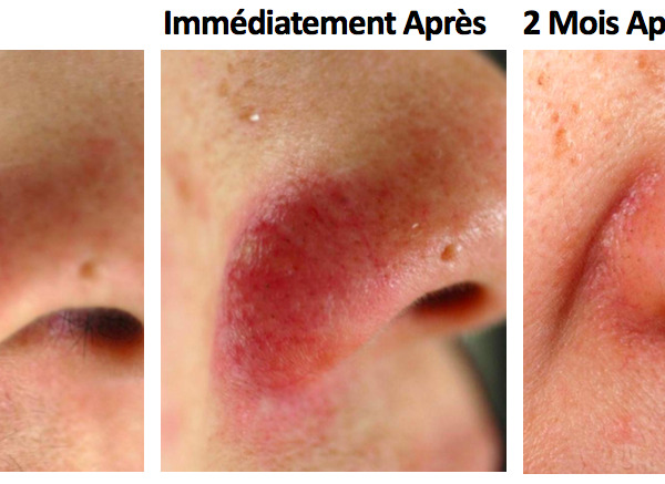 Traitement des cicatrices et de l'acné au laser à Nice (06 ...