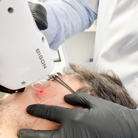 seance laser visage bison medical laser co2 fractionne laser resurfacing relissage cutane peau vieillissement nice cannes