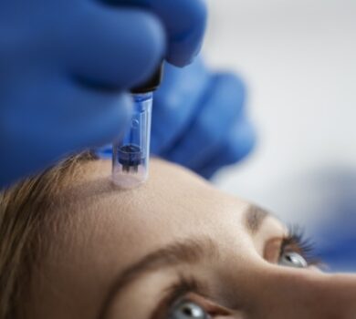 microneedling quand pourquoi faire nice cannes pores dilates rides cicatrices peau