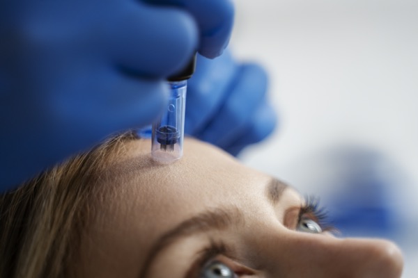 microneedling quand pourquoi faire nice cannes pores dilates rides cicatrices peau